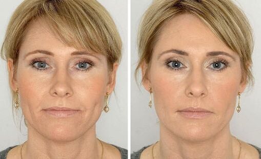 Photos before and after using the cream, experience of using Coralift Valerie de Paris