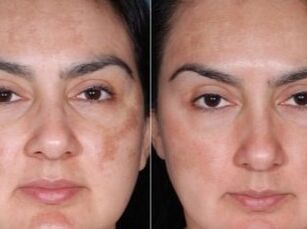 Before and after the rejuvenation procedure